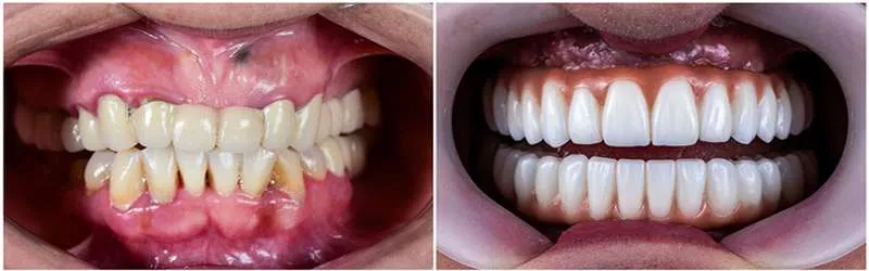 اگر ایمپلنت عفونت کند چه کنیم؟