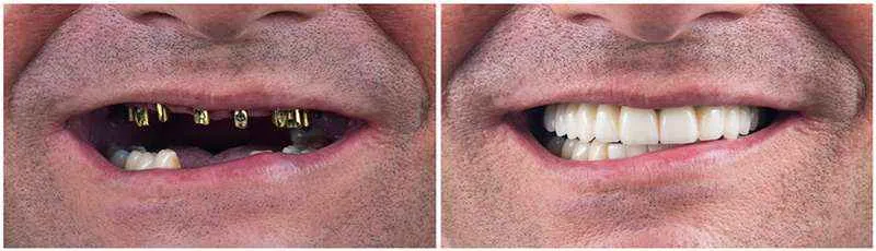 نمونه کار dental implant