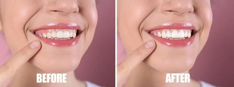 عکس قبل و بعد لیفت لثه