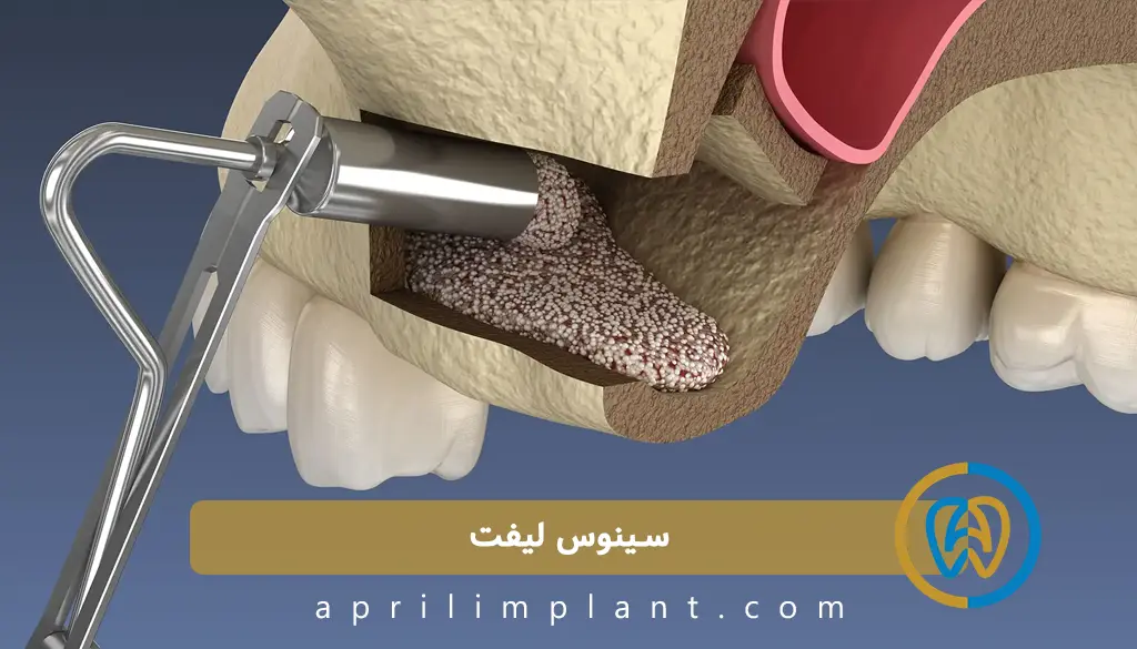 هزینه سینوس لیفت