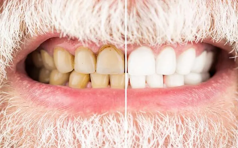 The cost of dental implants with social security insurance