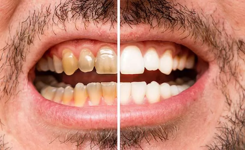 Dental implant cost with insurance