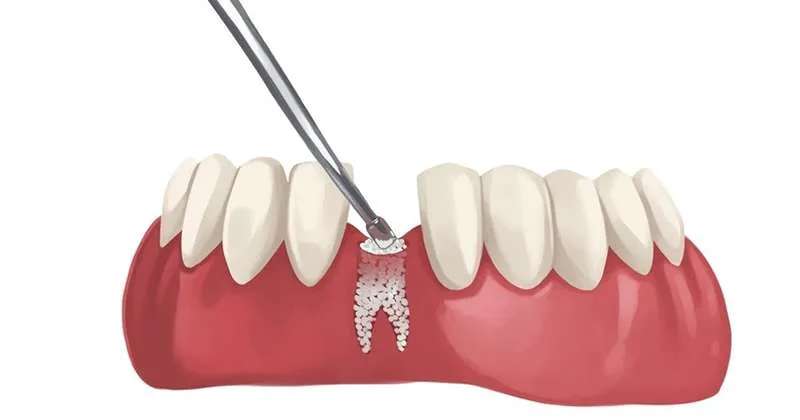 The cost of bone powder injection