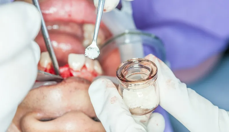 The cost of dental implant bone grafting