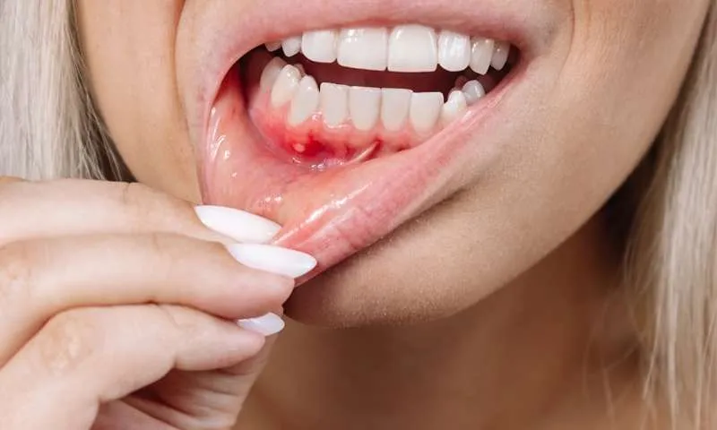 جلوگیری از آبسه لثه بعد از ایمپلنت