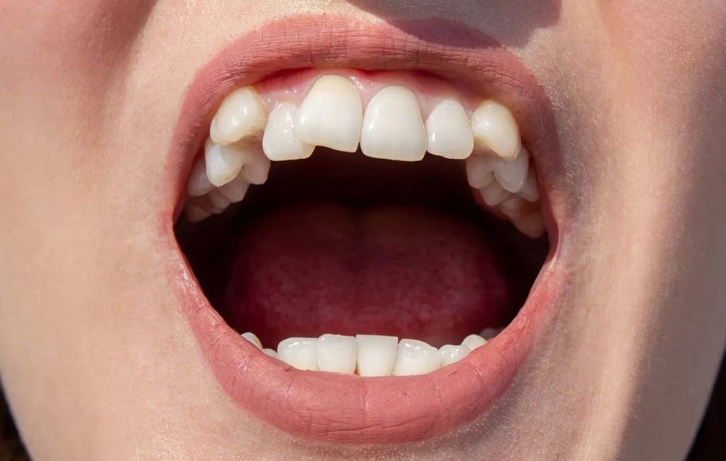 چرا از کامپوزیت دندان خرگوشی استفاده کنیم؟