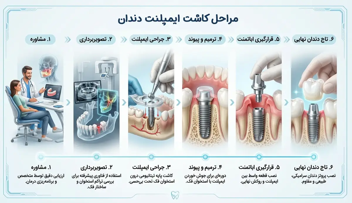 مراحل کاشت ایمپلنت دندان