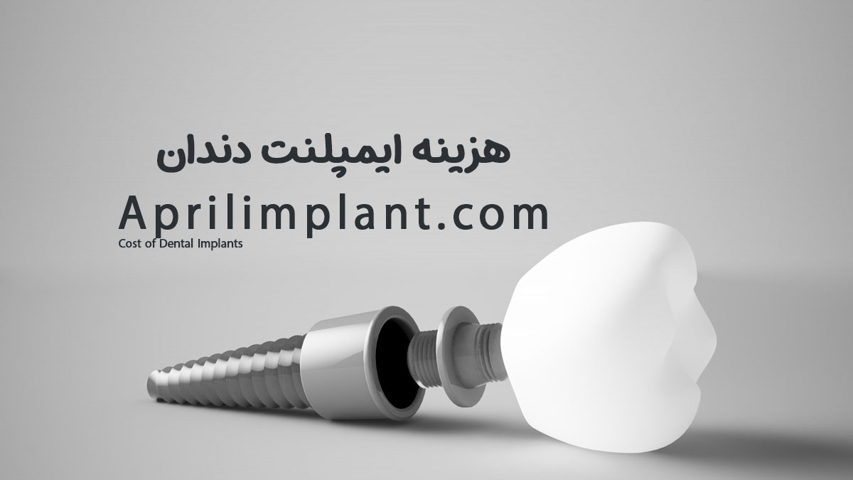 هزینه ایمپلنت دندان